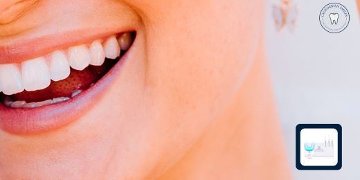 Quali sono i vantaggi dello sbiancamento dei denti con un kit?