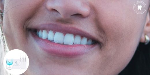 Come scegliere il miglior kit per lo sbiancamento dei denti?