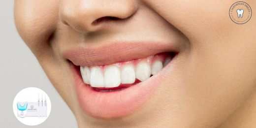 Quali risultati possiamo aspettarci da un kit di sbiancamento dei denti?