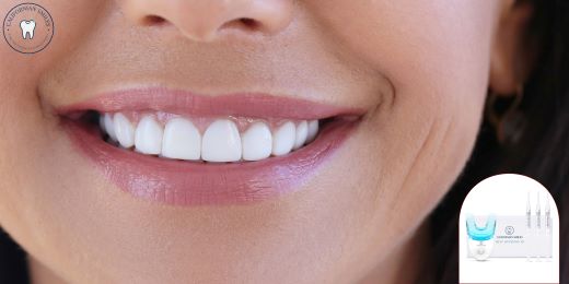 I kit per lo sbiancamento dei denti possono aiutare a rimuovere le macchie di fluorosi?